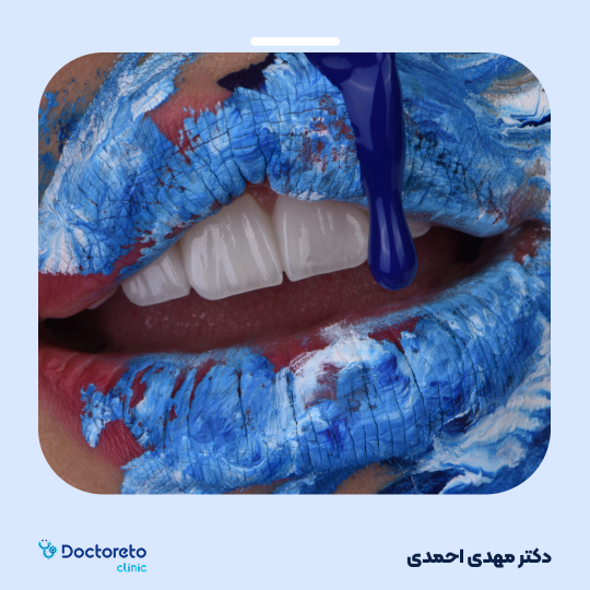 لمینت دندان (هر واحد)⬅️ دکتر مهدی احمدی در اصفهان 1