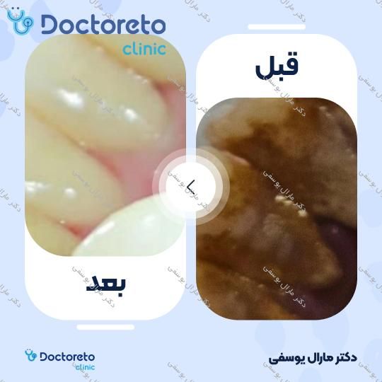 جرم گیری کامل دندان‌های دو فک با بروساژ🦷 دکتر مارال یوسفی در شیراز 1