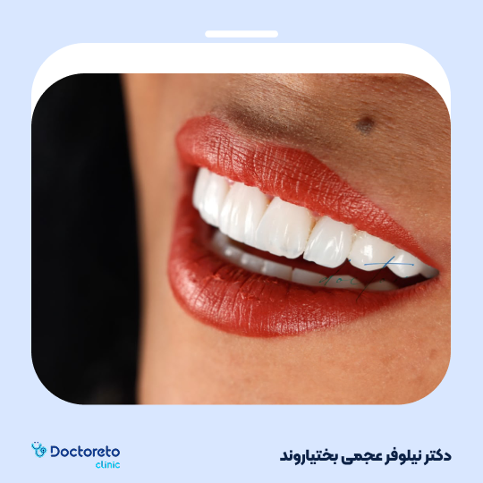 ونیر کامپوزیت (هر واحد)⬅️ دکتر نیلوفر عجمی بختیاروند در اصفهان 1