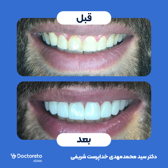 روکش دندان (هر واحد)⬅️ دکتر سید محمدمهدی خداپرست شریفی در کرج 1
