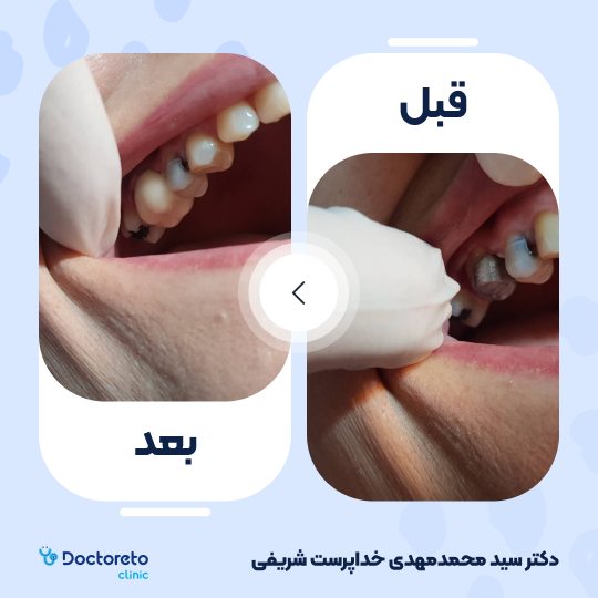 پر کردن دندان⬅️ دکتر سید محمدمهدی خداپرست شریفی در کرج 1