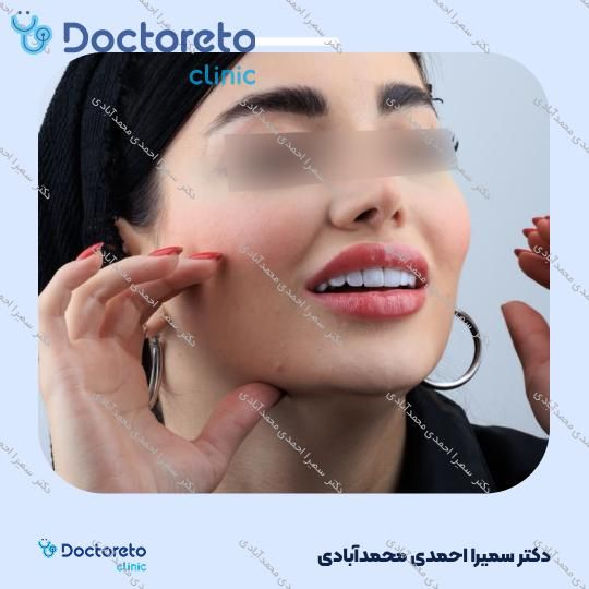 ونیر کامپوزیت (هر واحد)⬅️ دکتر سمیرا احمدی محمدآبادی در اصفهان 1