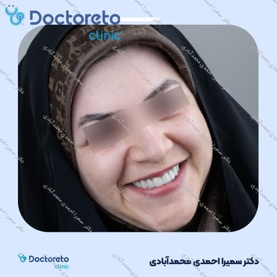 روکش دندان (هر واحد)⬅️ دکتر سمیرا احمدی محمدآبادی در اصفهان 1
