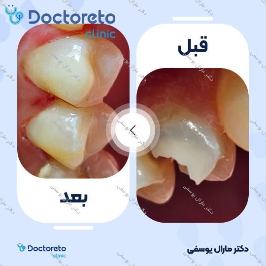 عصب کشی دندان⬅️ دکتر مارال یوسفی در شیراز 1