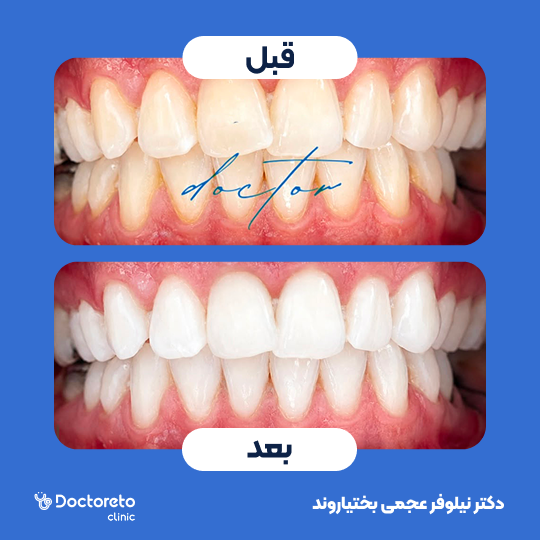بلیچینگ دندان (سفید کردن دندان) دکتر نیلوفر عجمی بختیاروند در اصفهان 1