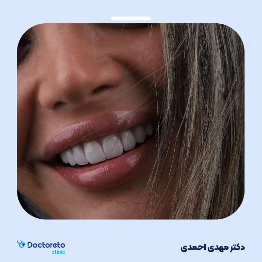 ونیر کامپوزیت (هر واحد)⬅️ دکتر مهدی احمدی در اصفهان 1