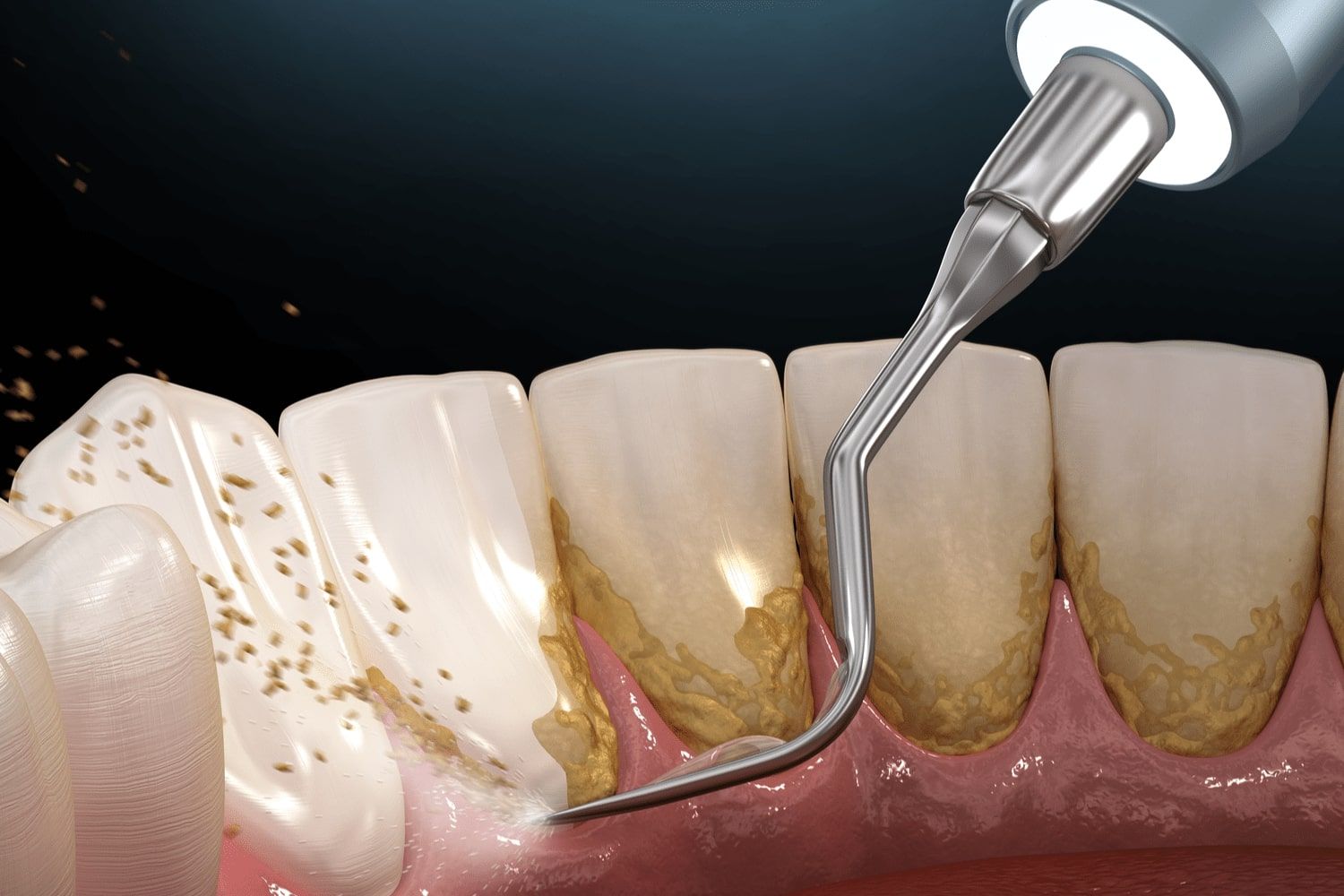 جرم گیری کامل دندان‌های دو فک با بروساژ🦷 دکتر سید محمدمهدی خداپرست شریفی در کرج 1