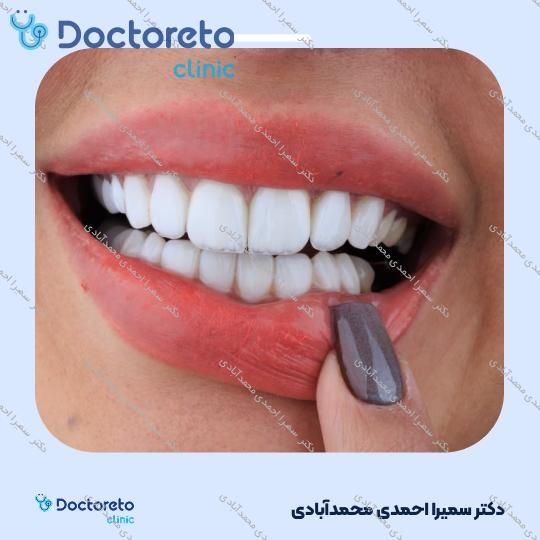 لمینت دندان (هر واحد)⬅️ دکتر سمیرا احمدی محمدآبادی در اصفهان 1