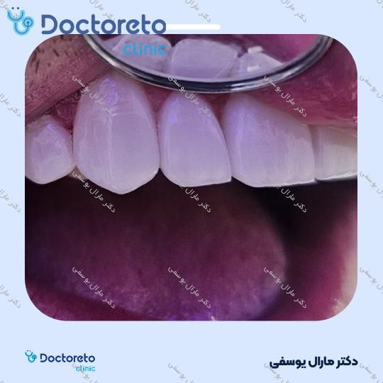 لمینت دندان (هر واحد)⬅️ دکتر مارال یوسفی در شیراز 1