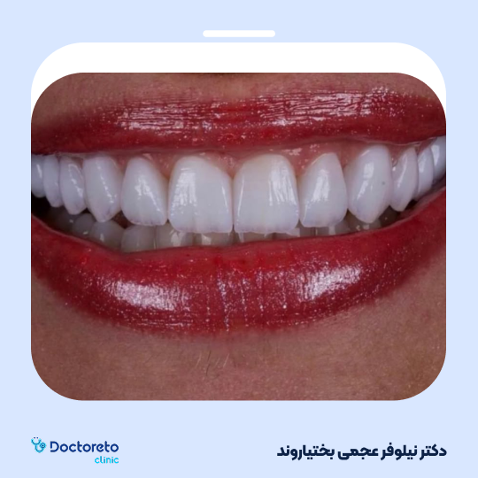 لمینت دندان (هر واحد)⬅️ دکتر نیلوفر عجمی بختیاروند در اصفهان 1