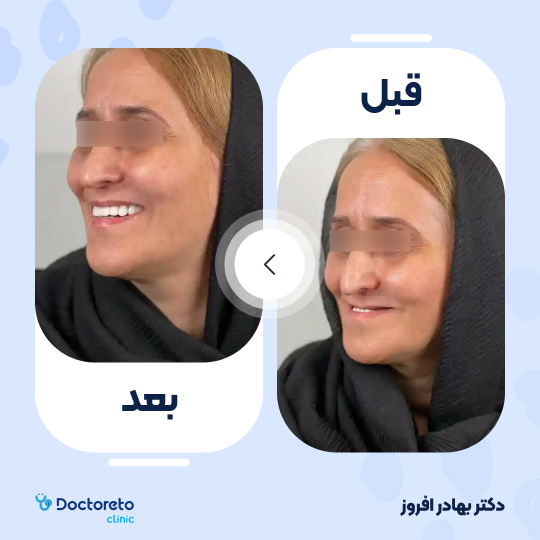 روکش دندان (هر واحد)⬅️ دکتر بهادر افروز در تهران 1
