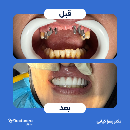 روکش دندان (هر واحد)⬅️ دکتر زهرا کیانی در تهران 1