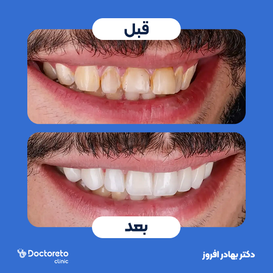 لمینت دندان (هر واحد)⬅️ دکتر بهادر افروز در تهران 1