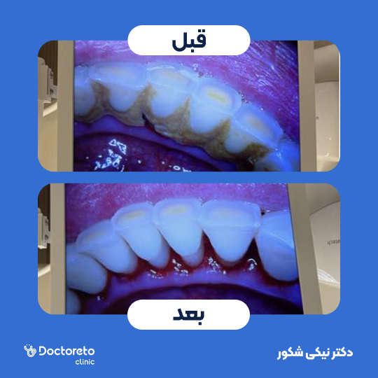 جرم گیری کامل دندان‌های دو فک با بروساژ🦷 دکتر نیکی شکور در تهران 1