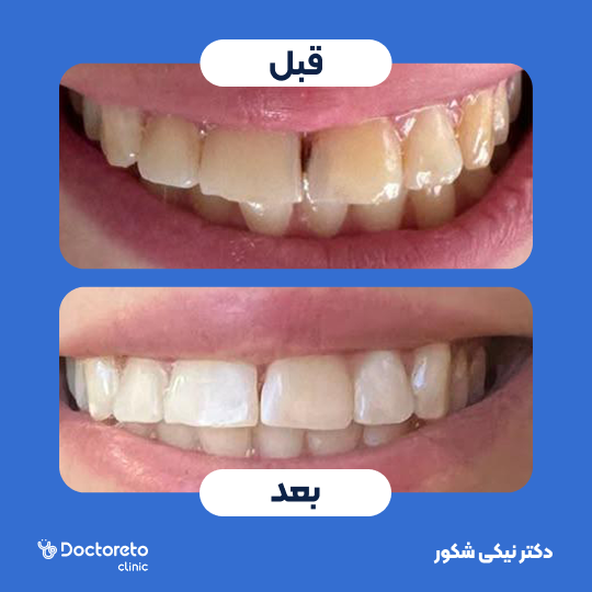 بلیچینگ دندان (سفید کردن دندان) دکتر نیکی شکور در تهران 1