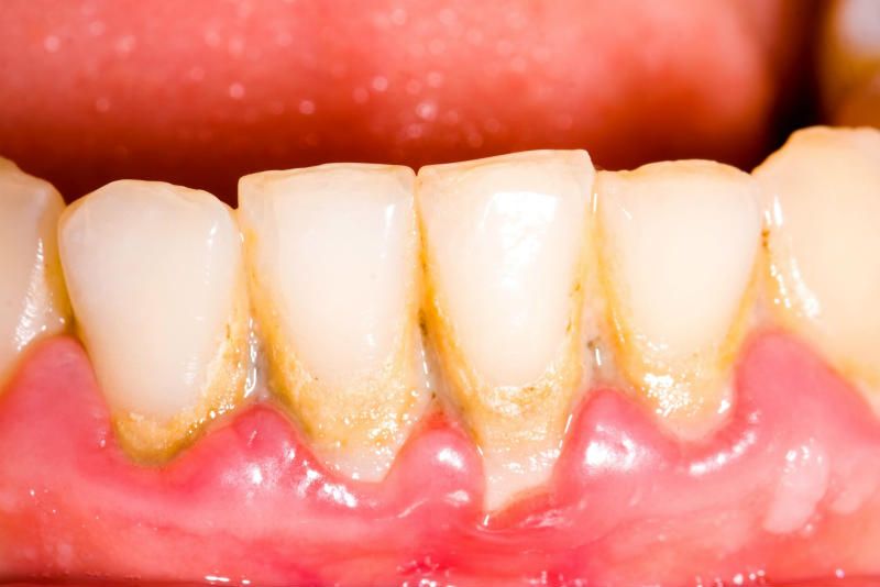 جرم گیری کامل دندان‌های دو فک با بروساژ🦷 دکتر غزاله کیوانی در تهران 1