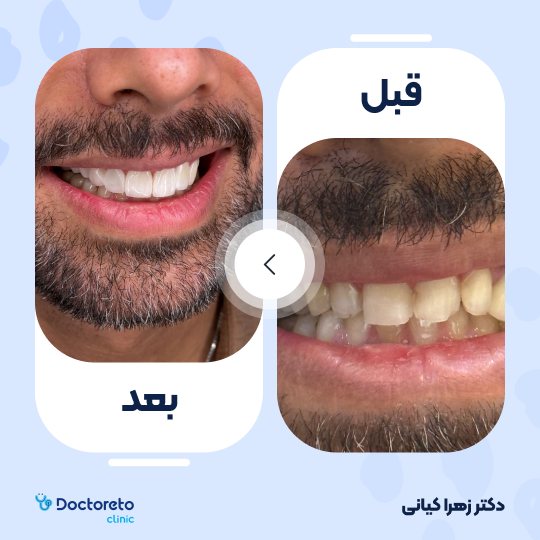 ونیر کامپوزیت (هر واحد)⬅️ دکتر زهرا کیانی در تهران 1