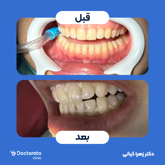 بلیچینگ دندان (سفید کردن دندان) دکتر زهرا کیانی در تهران 1