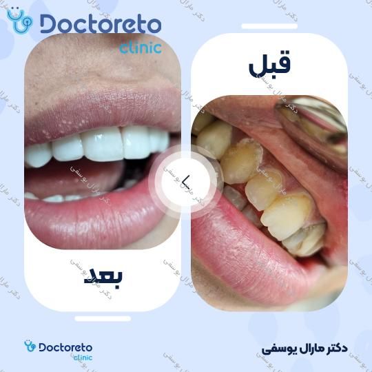 ونیر کامپوزیت (هر واحد)⬅️ دکتر مارال یوسفی در شیراز 1