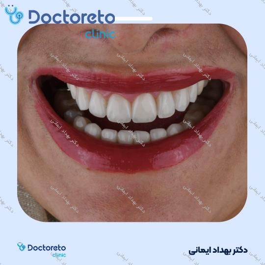 لمینت دندان (هر واحد)⬅️ دکتر بهداد ایمانی در تهران 1