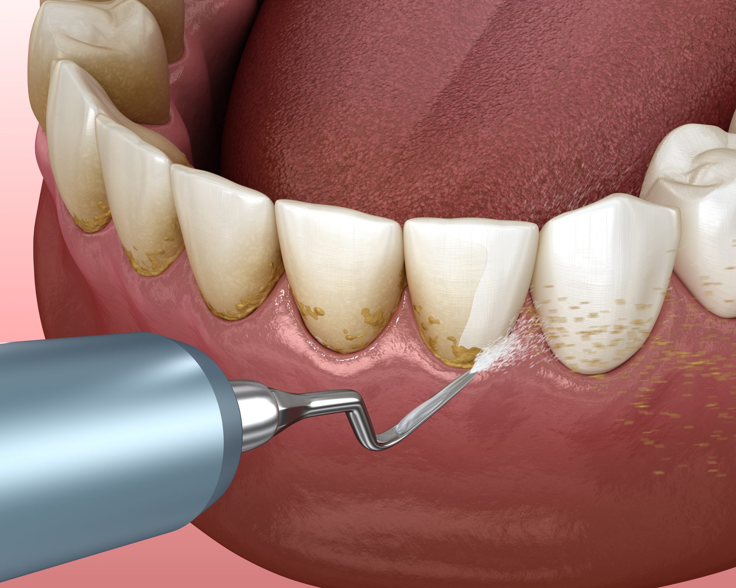 جرم گیری کامل دندان‌های دو فک با ایرفلو🦷 دکتر علیرضا تسلیمی در تهران 1