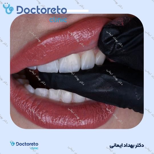 ونیر کامپوزیت (هر واحد)⬅️ دکتر بهداد ایمانی در تهران 1