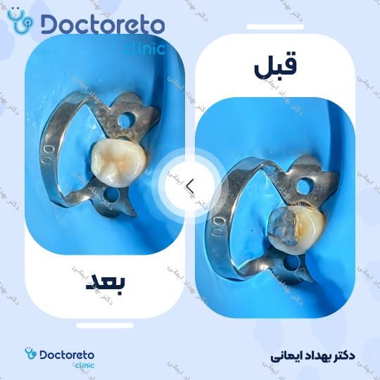 پر کردن دندان⬅️ دکتر بهداد ایمانی در تهران 1