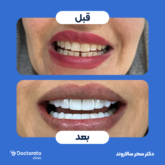 روکش دندان (هر واحد)⬅️ دکتر سحر سالاروند در تهران 1