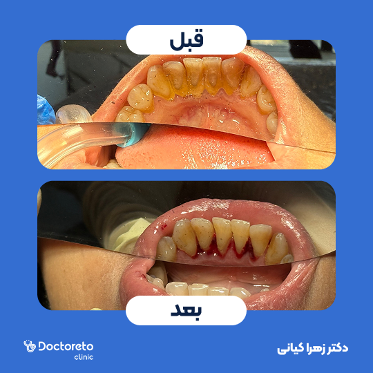 جرم گیری کامل دندان‌های دو فک با بروساژ🦷 دکتر زهرا کیانی در تهران 1