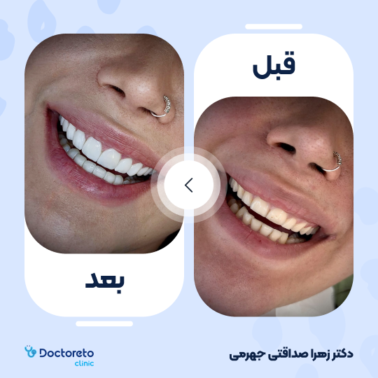 ونیر کامپوزیت (هر واحد)⬅️ دکتر زهرا صداقتی جهرمی در شیراز 1