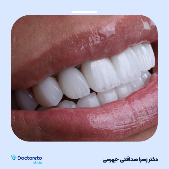 لمینت دندان (هر واحد)⬅️ دکتر زهرا صداقتی جهرمی در شیراز 1